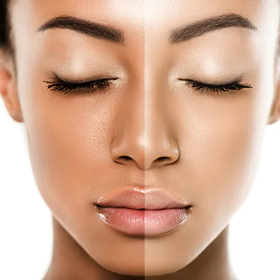 Skin Brightening